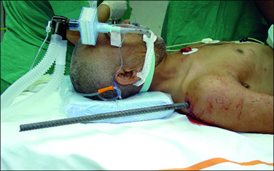 أطباء عرب ينقذون هندي بعد اختراق قضيب حديدي جسده! صورة رقم 2
