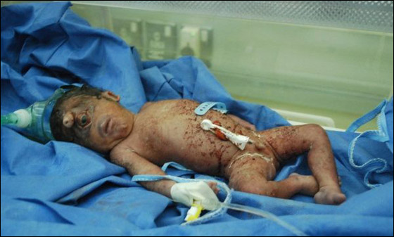 هل هو المسيح لدجال!! مولود عراقي بعين واحدة في جبينه!  صورة رقم 2