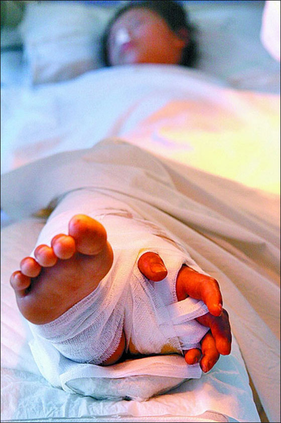 الصين: انقاذ يد طفلة بواسطة زرعها بجانب قدمها!!  صورة رقم 2
