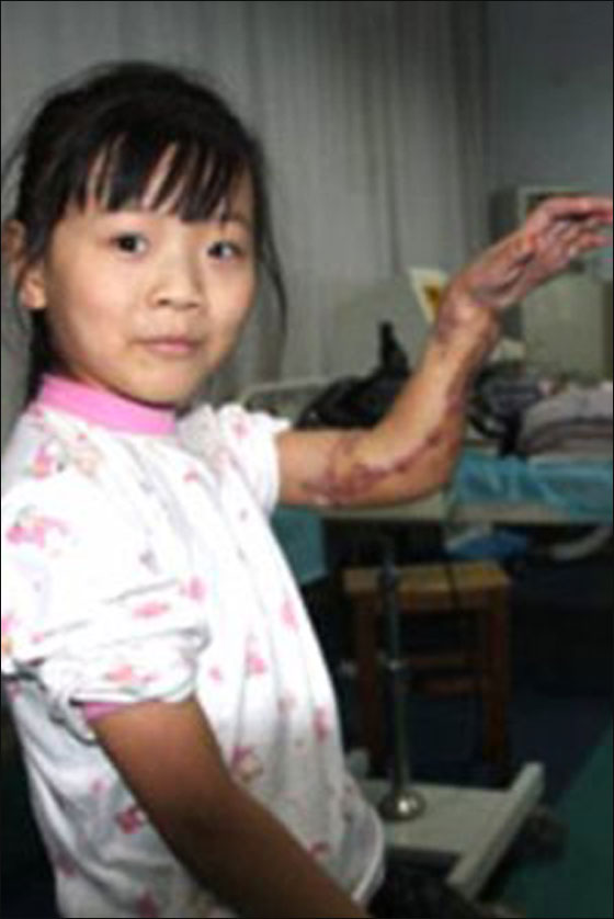 الصين: انقاذ يد طفلة بواسطة زرعها بجانب قدمها!!  صورة رقم 1
