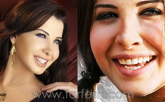 صور فنانين وفنانات اختلفت ملامحهم كليا بعد عمليات تجميل اسنانهم صورة رقم 3 صور فنانين وفنانات اختلفت ملامحهم كليا بعد عمليات تجميل اسنانهم صورة رقم 3