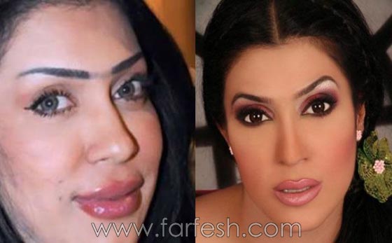 صور الفنانات قبل وبعد عمليات تجميل تكبير الشفاه صورة رقم 5 صور الفنانات قبل وبعد عمليات تجميل تكبير الشفاه صورة رقم 5