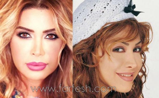 صور الفنانات قبل وبعد عمليات تجميل تكبير الشفاه صورة رقم 4 صور الفنانات قبل وبعد عمليات تجميل تكبير الشفاه صورة رقم 4