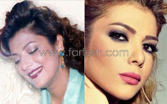 صور الفنانات قبل وبعد عمليات تجميل تكبير الشفاه صورة رقم 3 صور الفنانات قبل وبعد عمليات تجميل تكبير الشفاه صورة رقم 3