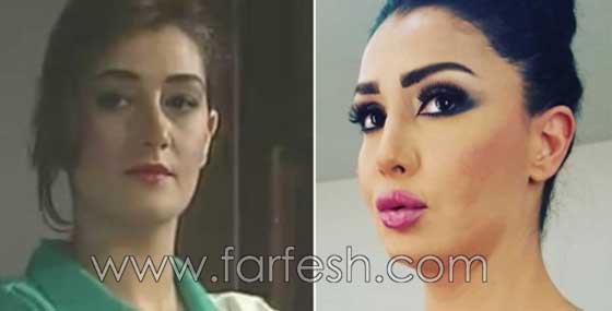 صور فنانات اجرين عمليات تجميل فاشلة نجم عنها التشويه الشلل والوفاة صورة رقم 5 صور فنانات اجرين عمليات تجميل فاشلة نجم عنها التشويه الشلل والوفاة صورة رقم 5