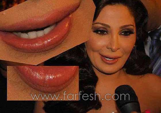 صور فنانات اجرين عمليات تجميل فاشلة نجم عنها التشويه الشلل والوفاة صورة رقم 15 صور فنانات اجرين عمليات تجميل فاشلة نجم عنها التشويه الشلل والوفاة صورة رقم 15