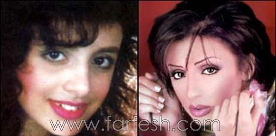 صور فنانات اجرين عمليات تجميل فاشلة نجم عنها التشويه الشلل والوفاة صورة رقم 10 صور فنانات اجرين عمليات تجميل فاشلة نجم عنها التشويه الشلل والوفاة صورة رقم 10