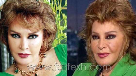 صور فنانات اجرين عمليات تجميل فاشلة نجم عنها التشويه الشلل والوفاة صورة رقم 2 صور فنانات اجرين عمليات تجميل فاشلة نجم عنها التشويه الشلل والوفاة صورة رقم 2