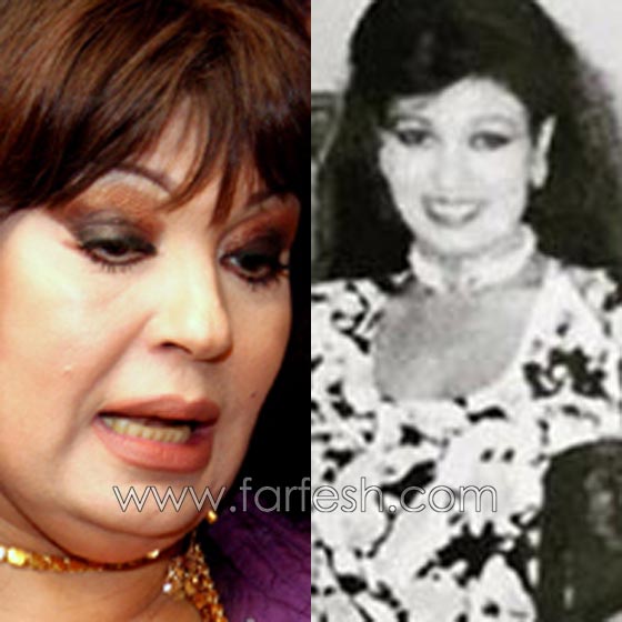 صور فنانات اجرين عمليات تجميل فاشلة نجم عنها التشويه الشلل والوفاة صورة رقم 8 صور فنانات اجرين عمليات تجميل فاشلة نجم عنها التشويه الشلل والوفاة صورة رقم 8
