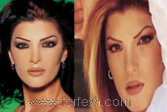 صور فنانات اجرين عمليات تجميل فاشلة نجم عنها التشويه الشلل والوفاة صورة رقم 13 صور فنانات اجرين عمليات تجميل فاشلة نجم عنها التشويه الشلل والوفاة صورة رقم 13