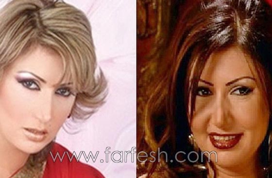صور فنانات اجرين عمليات تجميل فاشلة نجم عنها التشويه الشلل والوفاة صورة رقم 12 صور فنانات اجرين عمليات تجميل فاشلة نجم عنها التشويه الشلل والوفاة صورة رقم 12