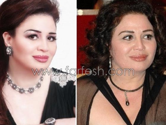 صور فنانات اجرين عمليات تجميل فاشلة نجم عنها التشويه الشلل والوفاة صورة رقم 9 صور فنانات اجرين عمليات تجميل فاشلة نجم عنها التشويه الشلل والوفاة صورة رقم 9