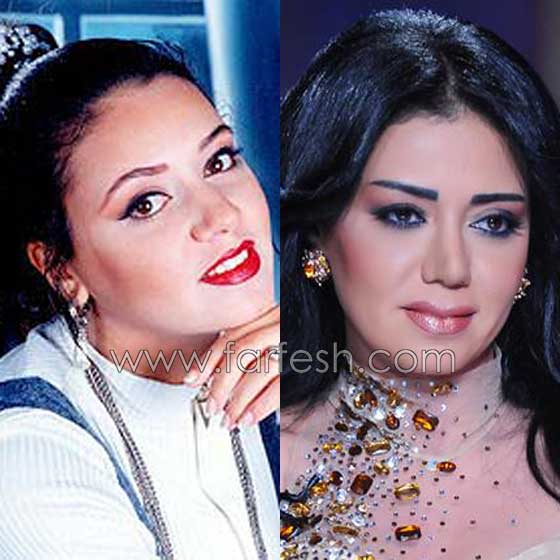 صور فنانات اجرين عمليات تجميل فاشلة نجم عنها التشويه الشلل والوفاة صورة رقم 7 صور فنانات اجرين عمليات تجميل فاشلة نجم عنها التشويه الشلل والوفاة صورة رقم 7