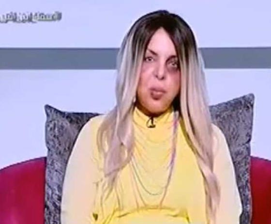 مذيعة مصرية ظهرت على الهواء وعلى وجهها علامات الضرب والسبب؟! فيديو صورة رقم 1