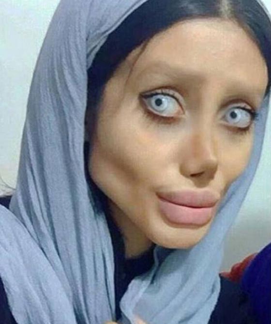 50 عملية تجميل لتشبه أنجيلينا جولي فتحوّلت الى غول وشبه جثة!  صورة رقم 7