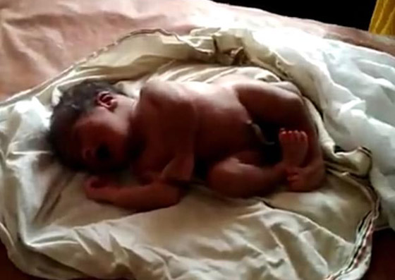 الطفل المعجزة.. ولادة طفل بأربعة أرجل وعضوين ذكريين في الهند! صورة رقم 2