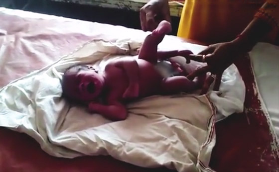 الطفل المعجزة.. ولادة طفل بأربعة أرجل وعضوين ذكريين في الهند! صورة رقم 6