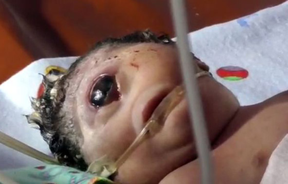 فيديو صادم.. ولادة طفلة بعين واحدة وبدون أنف في إندونيسيا صورة رقم 1