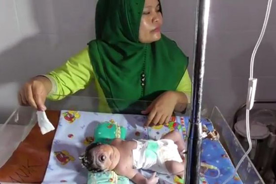 فيديو صادم.. ولادة طفلة بعين واحدة وبدون أنف في إندونيسيا صورة رقم 2
