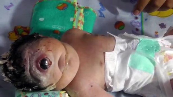 فيديو صادم.. ولادة طفلة بعين واحدة وبدون أنف في إندونيسيا صورة رقم 3