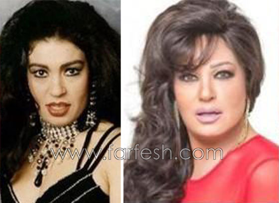 صور 14 فنانة مصرية قبل وبعد عمليات التجميل.. الفرق هائل! صورة رقم 2
