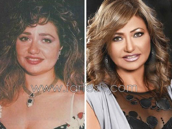 صور 14 فنانة مصرية قبل وبعد عمليات التجميل.. الفرق هائل! صورة رقم 4