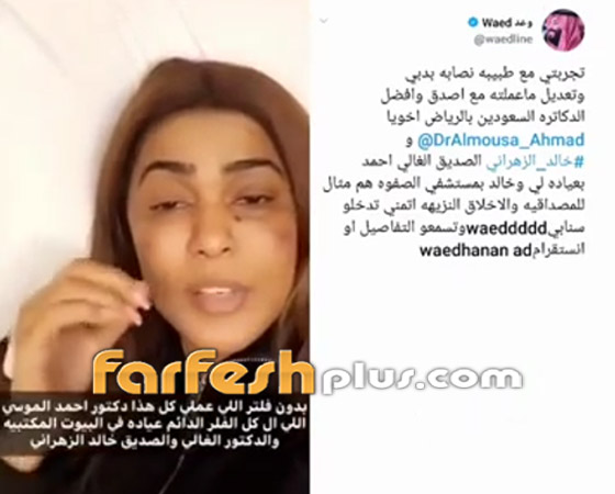 الفنانة السعودية وعد تتهم طبيبة تجميل بتشويه وجهها ثم تحذف الفيديو! صورة رقم 1