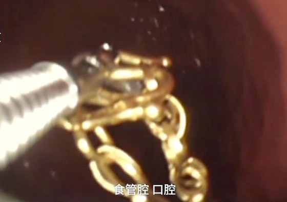 بالفيديو: سيدة تبتلع سلسلتها الذهبية بسبب شجار عائلي صورة رقم 1
