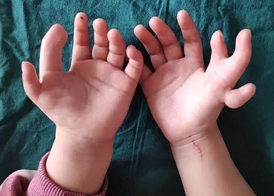 إزالة الأصابع الزائدة لطفلة صينية ولدت بـ14 إصبعا في اليدين! صور صورة رقم 1