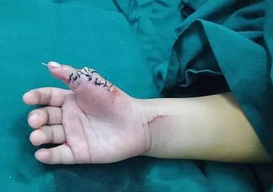 إزالة الأصابع الزائدة لطفلة صينية ولدت بـ14 إصبعا في اليدين! صور صورة رقم 5