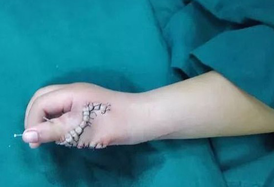 إزالة الأصابع الزائدة لطفلة صينية ولدت بـ14 إصبعا في اليدين! صور صورة رقم 6