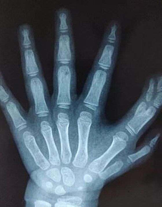 إزالة الأصابع الزائدة لطفلة صينية ولدت بـ14 إصبعا في اليدين! صور صورة رقم 2