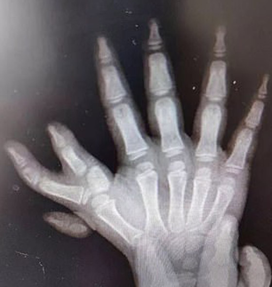 إزالة الأصابع الزائدة لطفلة صينية ولدت بـ14 إصبعا في اليدين! صور صورة رقم 3