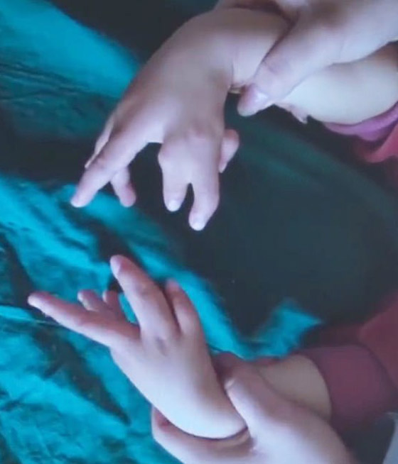 إزالة الأصابع الزائدة لطفلة صينية ولدت بـ14 إصبعا في اليدين! صور صورة رقم 4