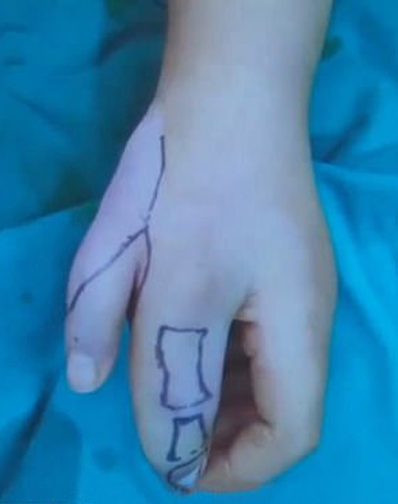 إزالة الأصابع الزائدة لطفلة صينية ولدت بـ14 إصبعا في اليدين! صور صورة رقم 7