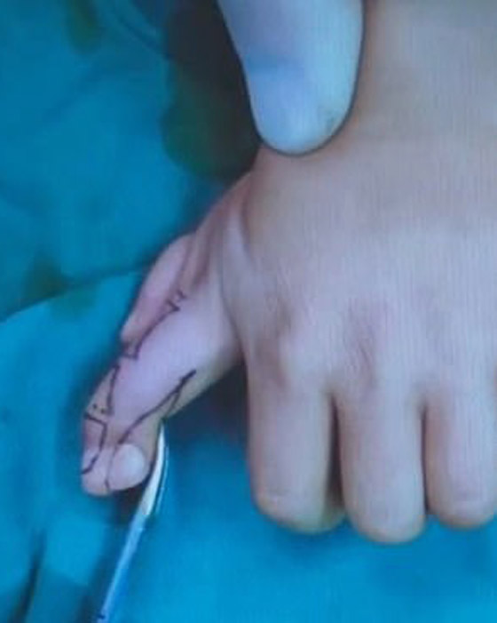 إزالة الأصابع الزائدة لطفلة صينية ولدت بـ14 إصبعا في اليدين! صور صورة رقم 8