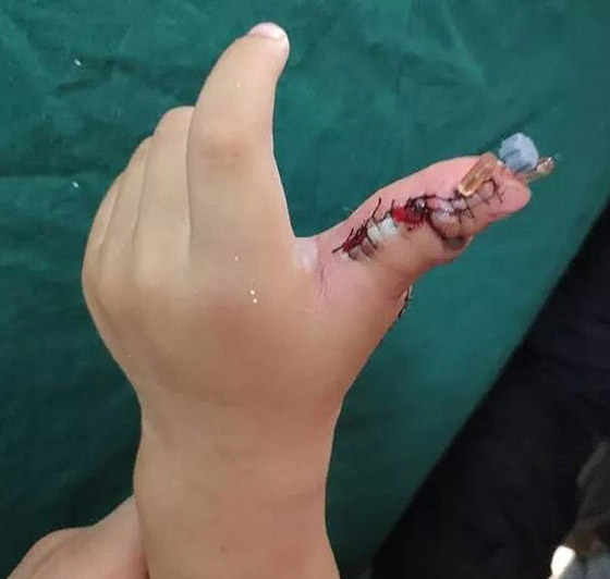 إزالة الأصابع الزائدة لطفلة صينية ولدت بـ14 إصبعا في اليدين! صور صورة رقم 11