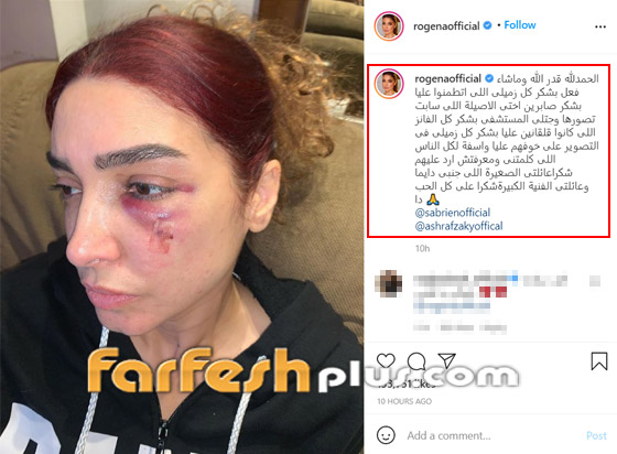 إصابة مروعة لروجينا أثناء تصوير مسلسل (بنت السلطان)! وأول تعليق لها صورة رقم 3