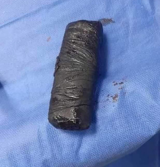 صور: استخراج هاتف محمول من بطن شاب مصري صورة رقم 2