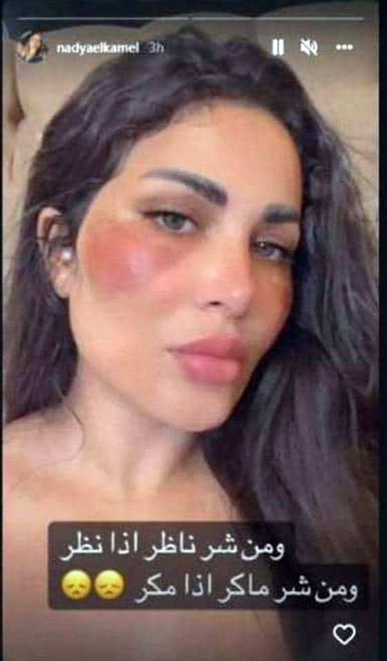 هجوم على ندى الكامل طليقة أحمد الفيشاوي لتحريف آية قرآنية وتزعم حرق وجهها! صورة رقم 4