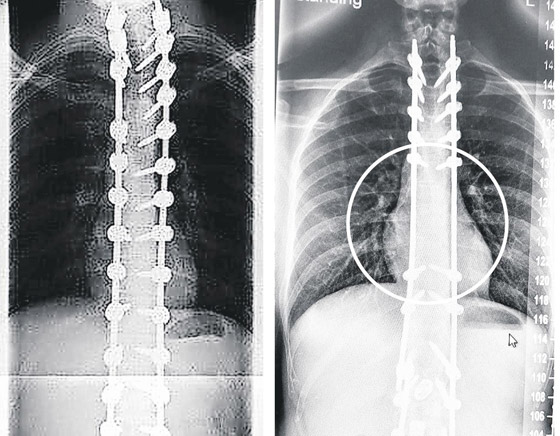 وضع مسامير بطريقة خاطئة بظهور مرضاه! أخطاء كارثية لجراح بمستشفى بريطاني عريق صورة رقم 3