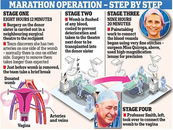 أخت تبرعت لشقيقتها.. نجاح أول عملية زراعة رحم في بريطانيا! فيديو صورة رقم 7
