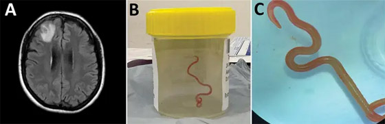 لأول مرة في العالم.. دودة ثعبان حية في دماغ مريضة! صور صورة رقم 3