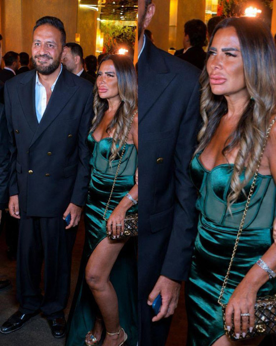 زوجة فنان مصري تشعل ضجة بسبب تشوه شفتيها بعد عملية حقن (فيلر) فاشلة! تبدو كأنها بـ شنب! صورة رقم 1 زوجة فنان مصري تشعل ضجة بسبب تشوه شفتيها بعد عملية حقن (فيلر) فاشلة! تبدو كأنها بـ شنب! صورة رقم 1