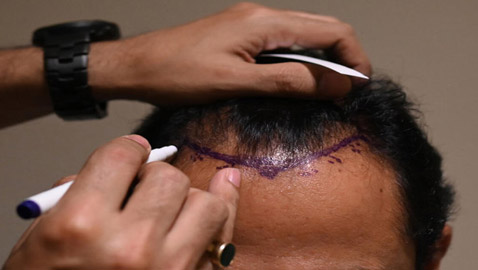 يجريها هواة على يوتيوب! عملية زراعة الشعر تتسبب بمقتل رجل هندي